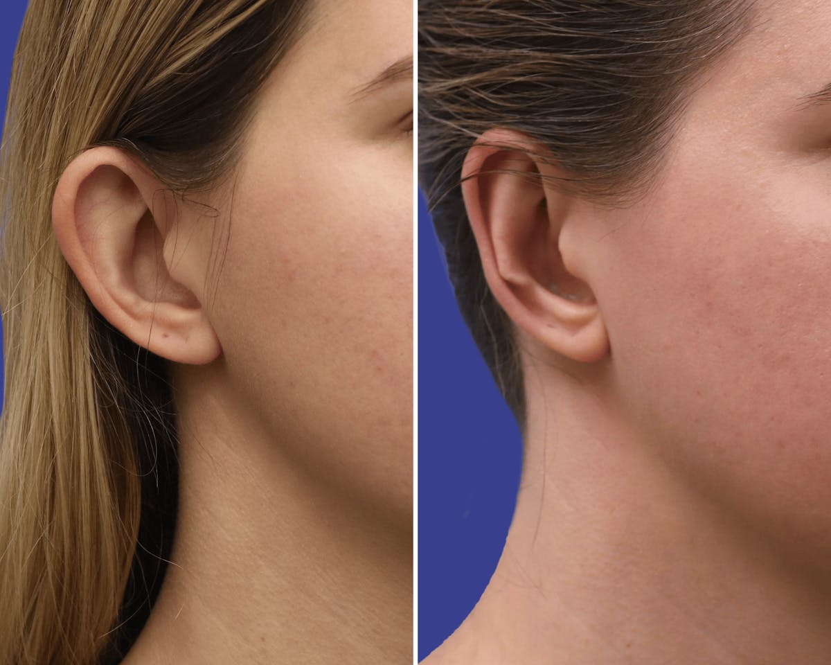 Otoplasty Before & After Gallery - Patient 409463 - Image 3