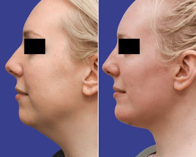 Chin Implants Before & After Gallery - Patient 496388 - Image 1