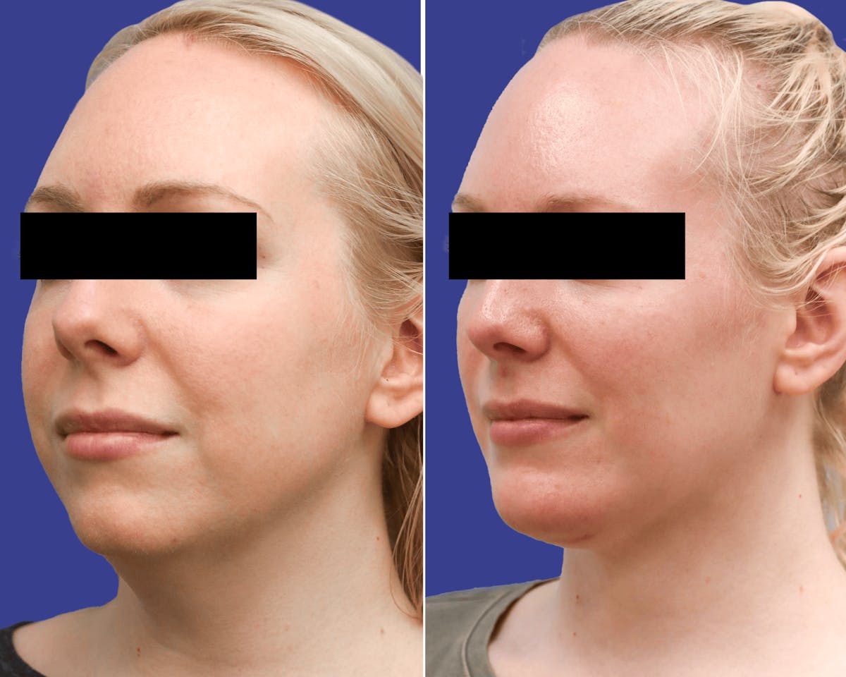 Chin Implants Before & After Gallery - Patient 496388 - Image 2