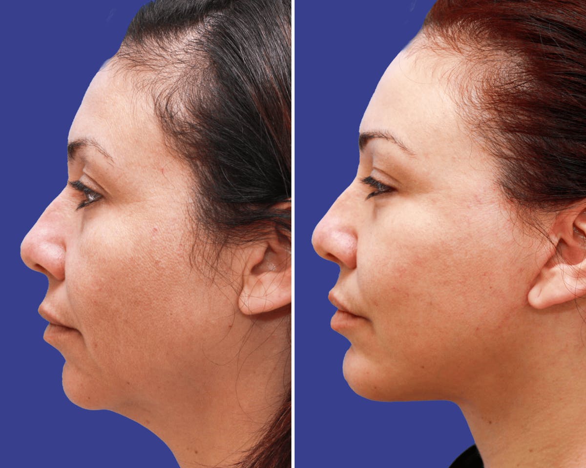 Chin Implants Before & After Gallery - Patient 136453 - Image 1