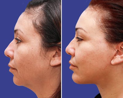 Chin Implants Before & After Gallery - Patient 136453 - Image 1