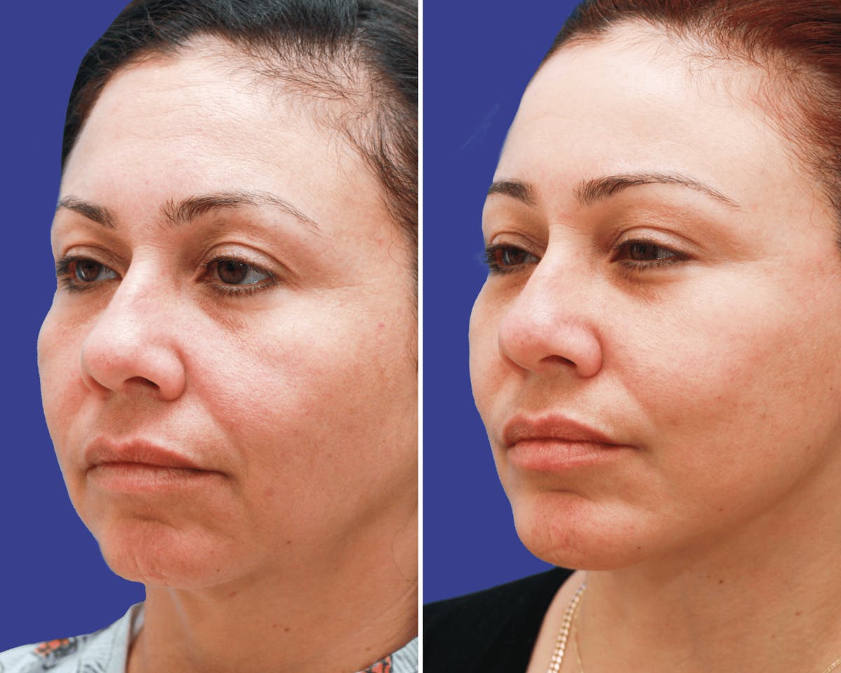 Chin Implants Before & After Gallery - Patient 136453 - Image 2