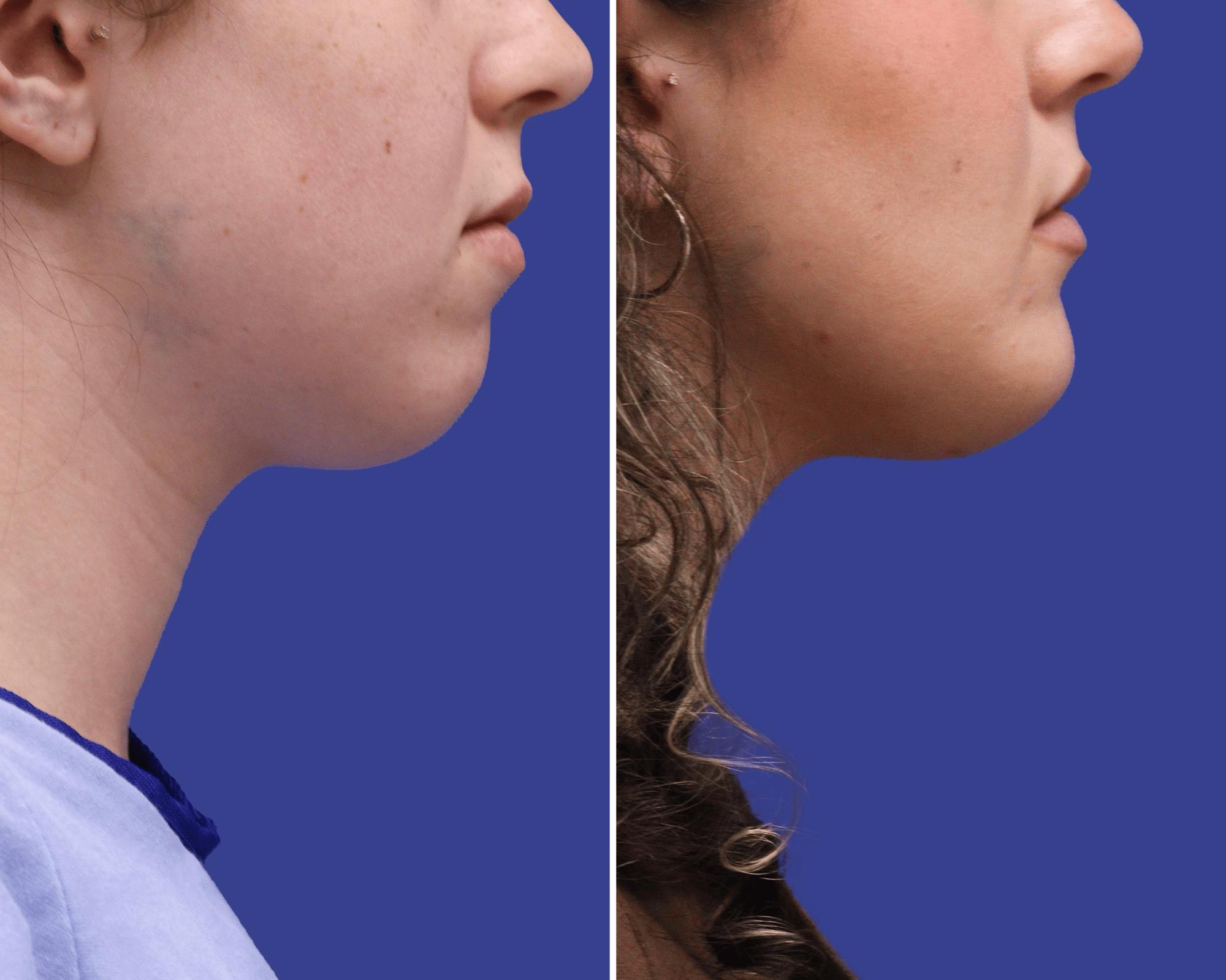 Chin Implants Before & After Gallery - Patient 310556 - Image 2