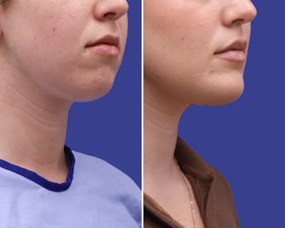 Chin Implants Before & After Gallery - Patient 310556 - Image 1