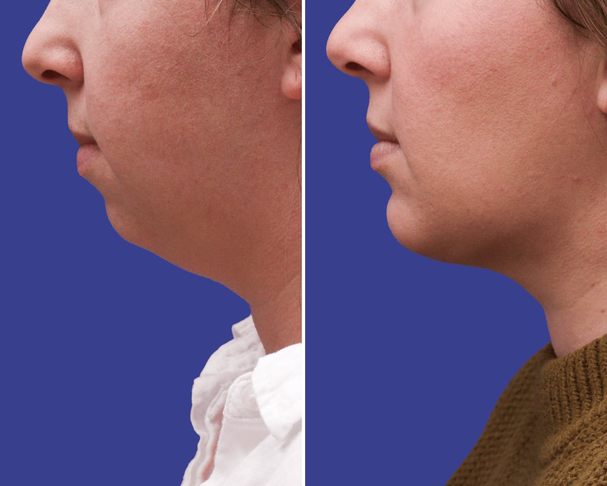 Chin Implants Before & After Gallery - Patient 237528 - Image 1