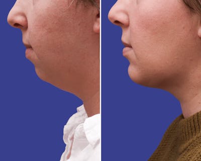 Chin Implants Before & After Gallery - Patient 237528 - Image 1