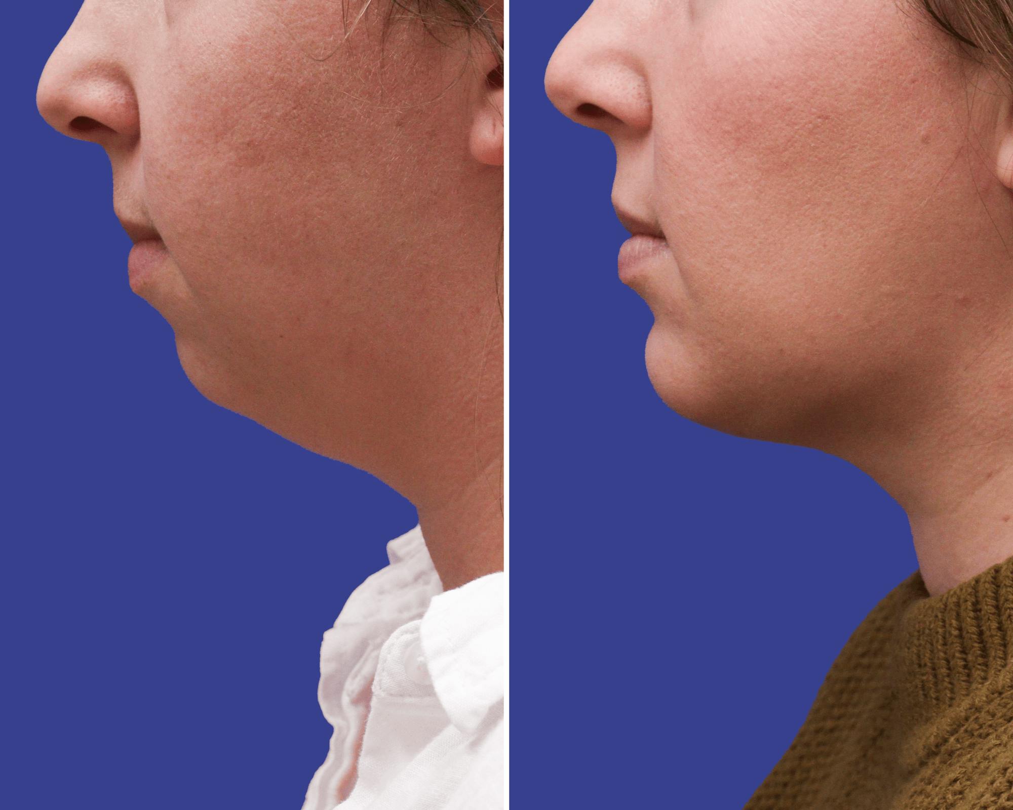 Chin Implants Before & After Gallery - Patient 237528 - Image 1