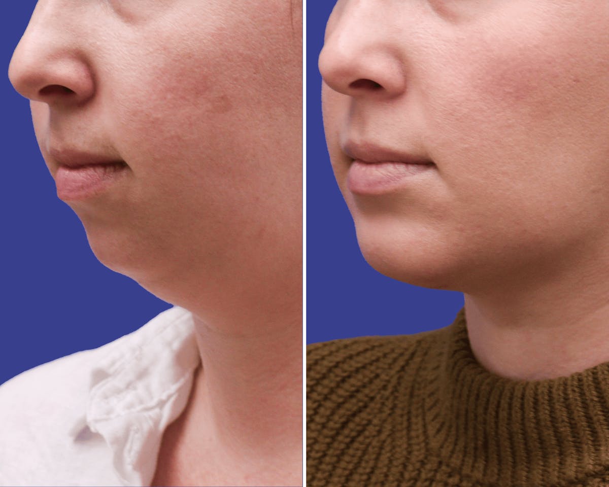 Chin Implants Before & After Gallery - Patient 237528 - Image 2