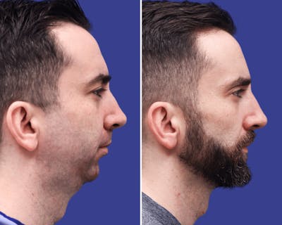 Chin Implants Before & After Gallery - Patient 899030 - Image 1