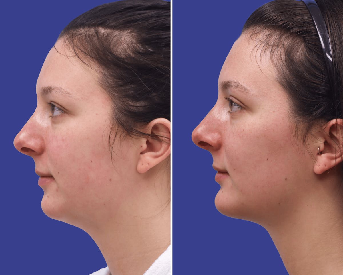 Neck Before & After Gallery - Patient 461642 - Image 1