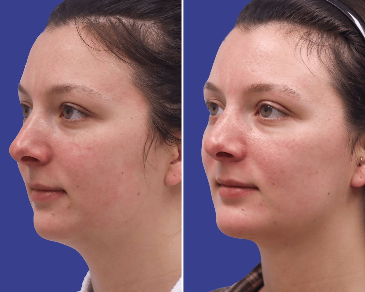 Neck Before & After Gallery - Patient 461642 - Image 2