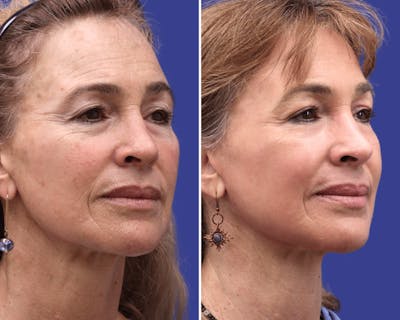 CO2 Laser Resurfacing Before & After Gallery - Patient 338009 - Image 1