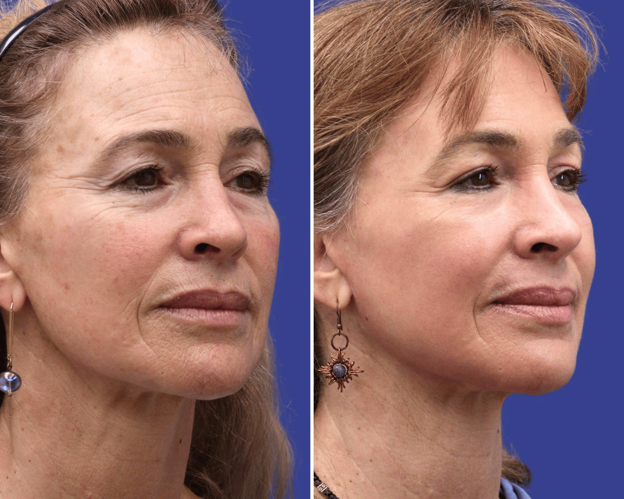 CO2 Laser Resurfacing Before & After Gallery - Patient 338009 - Image 1