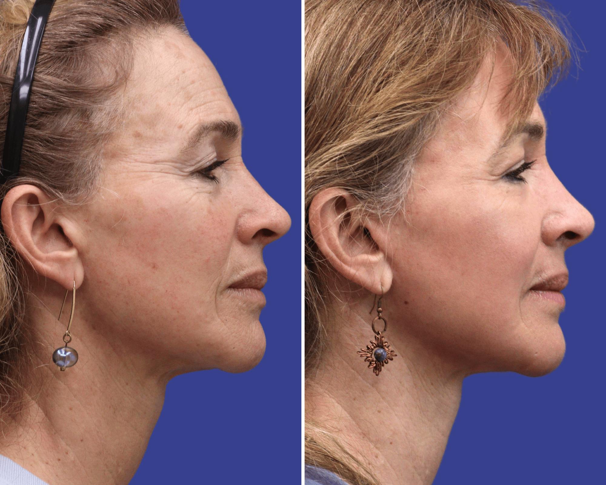 CO2 Laser Resurfacing Before & After Gallery - Patient 338009 - Image 2