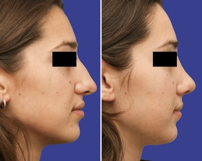 Rhinoplasty Before & After Gallery - Patient 190040 - Image 1