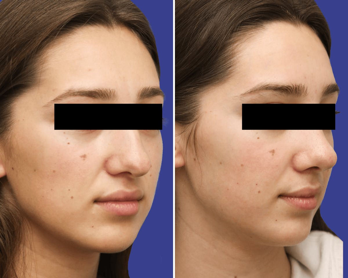 Rhinoplasty Before & After Gallery - Patient 190040 - Image 2