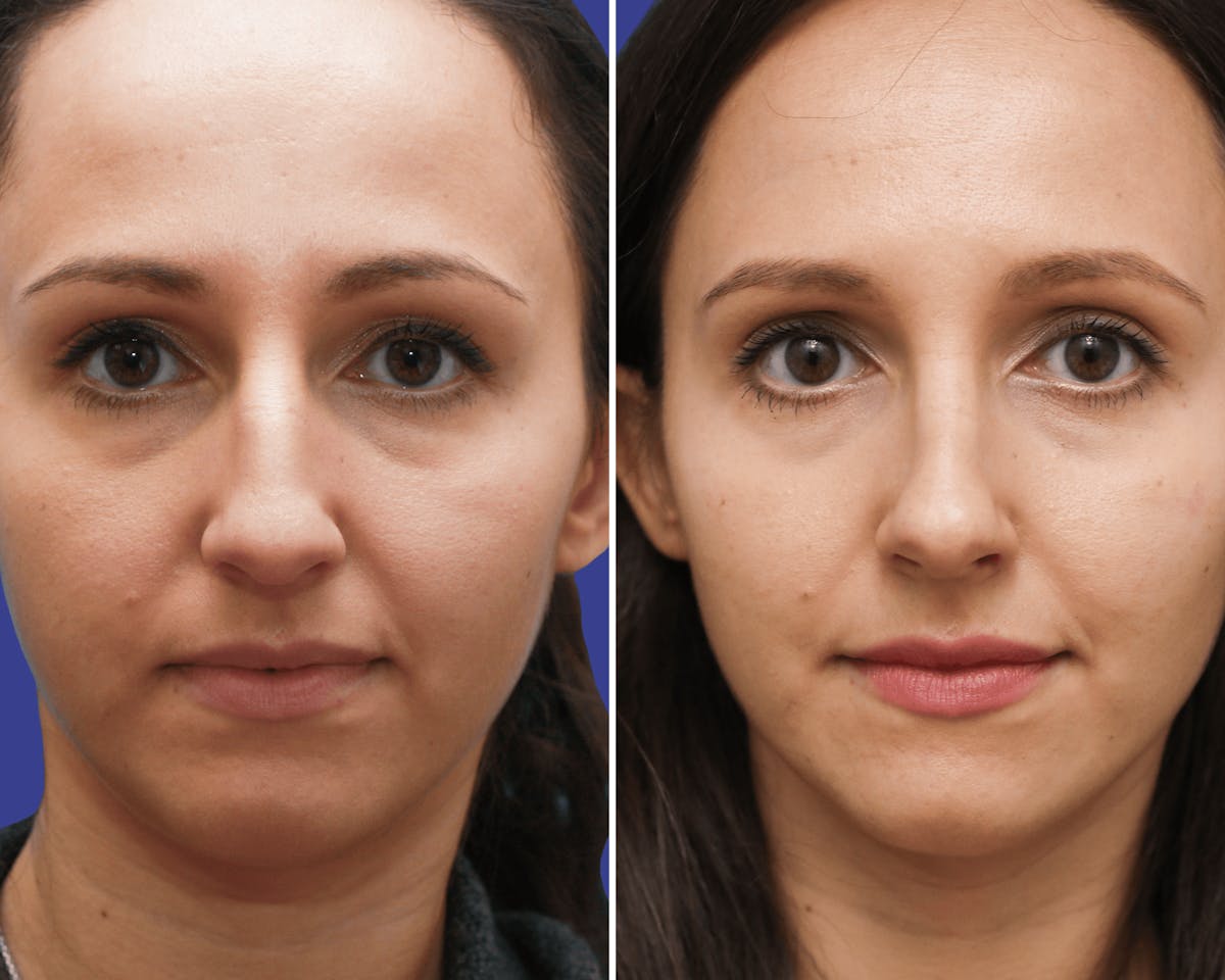 Rhinoplasty Before & After Gallery - Patient 323646 - Image 3
