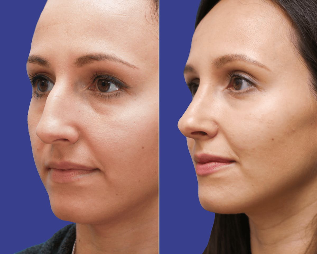 Rhinoplasty Before & After Gallery - Patient 323646 - Image 2