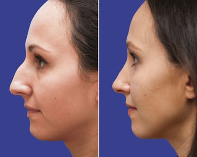 Rhinoplasty Before & After Gallery - Patient 323646 - Image 1