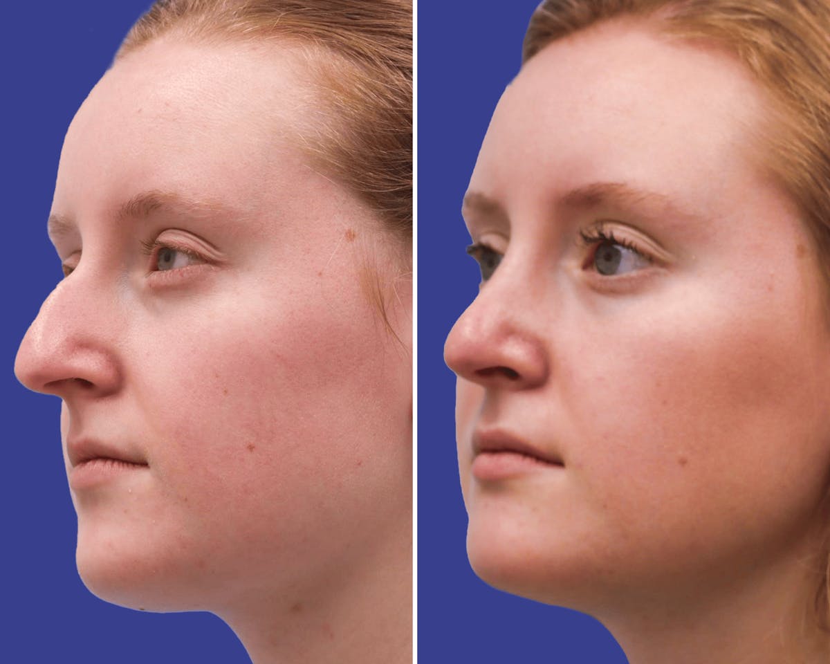 Rhinoplasty Before & After Gallery - Patient 259541 - Image 2