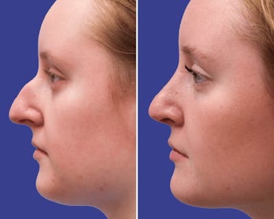Rhinoplasty Before & After Gallery - Patient 259541 - Image 1