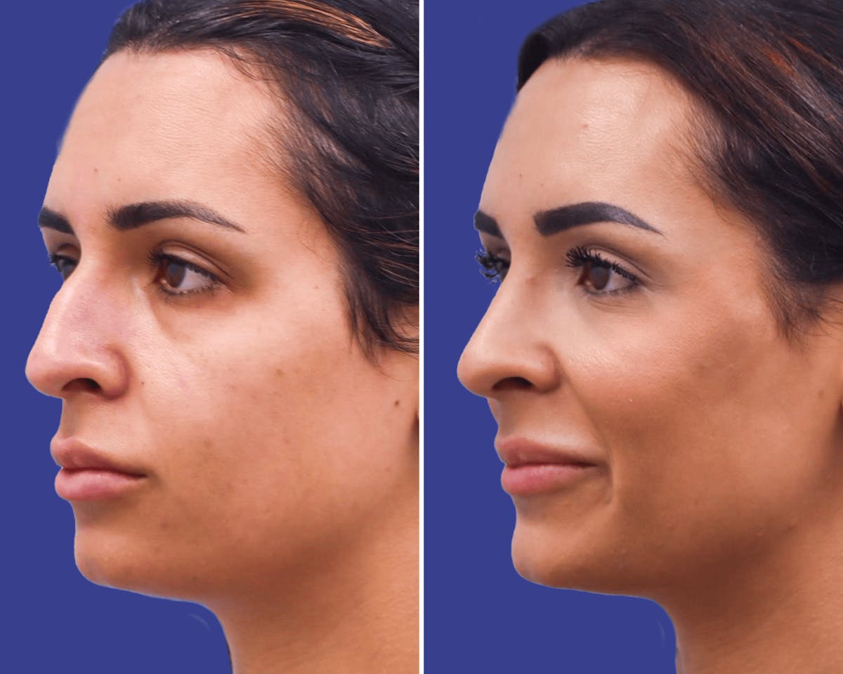 Rhinoplasty Before & After Gallery - Patient 532311 - Image 2