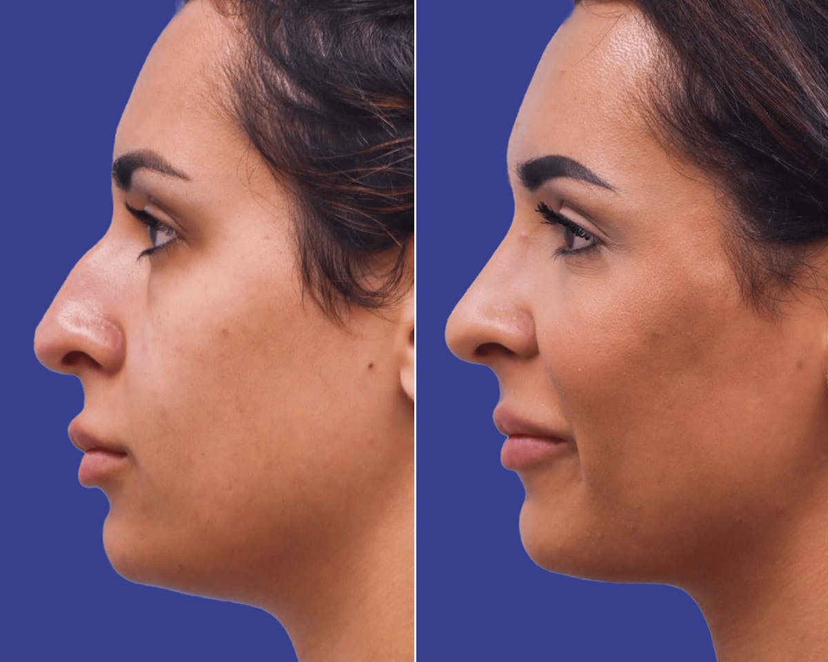 Rhinoplasty Before & After Gallery - Patient 532311 - Image 1