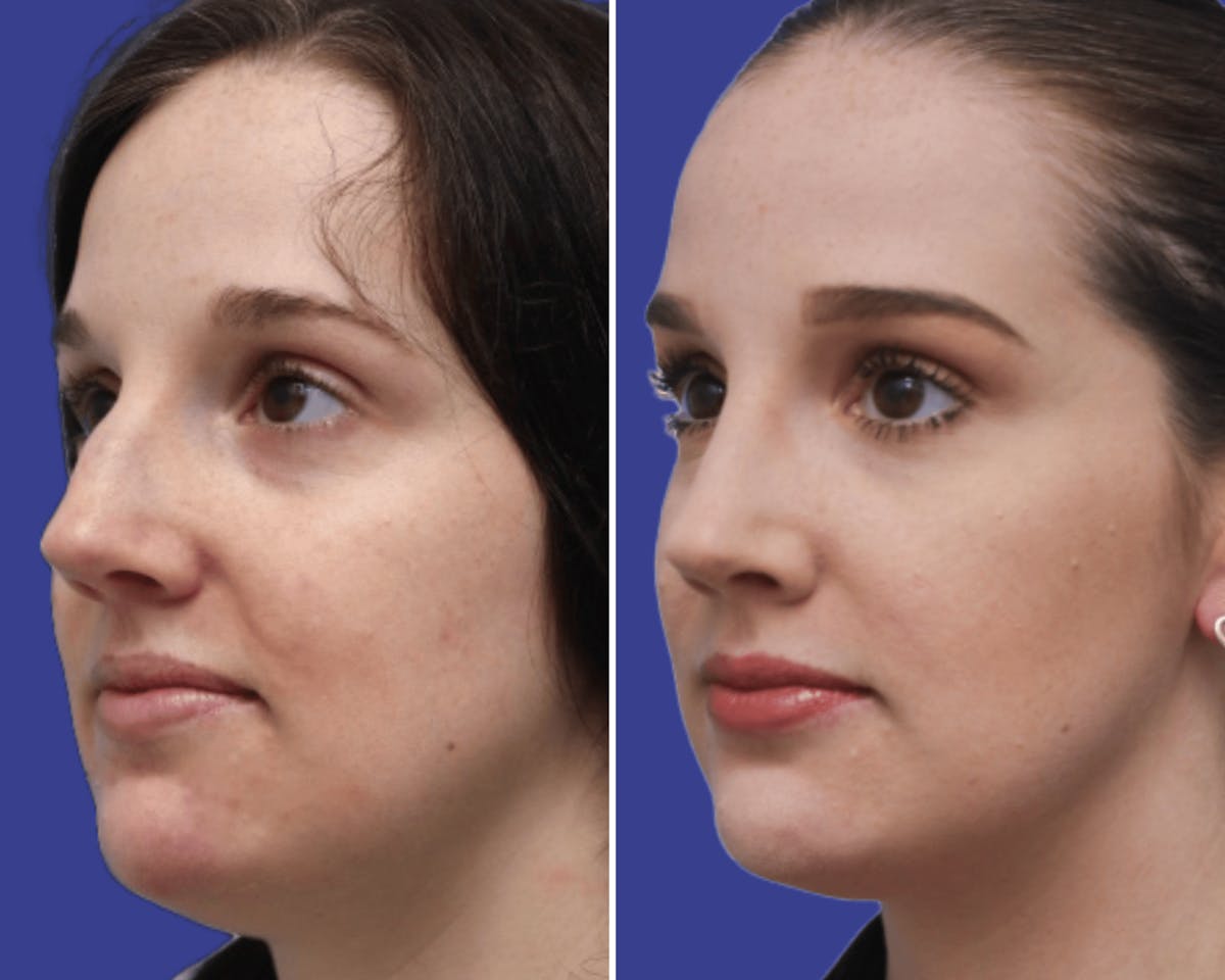Rhinoplasty Before & After Gallery - Patient 355511 - Image 2