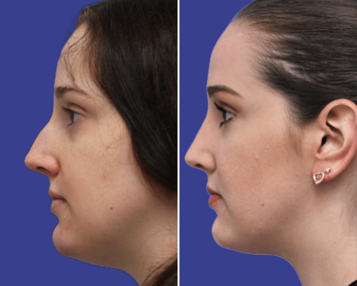 Rhinoplasty Before & After Gallery - Patient 355511 - Image 1