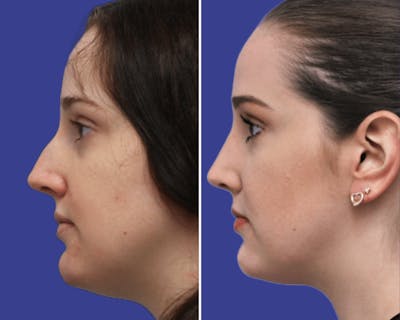 Rhinoplasty Before & After Gallery - Patient 355511 - Image 1