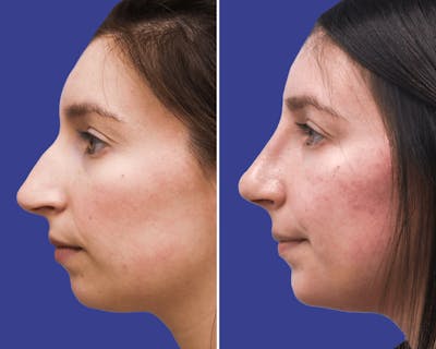 Rhinoplasty Before & After Gallery - Patient 316055 - Image 1