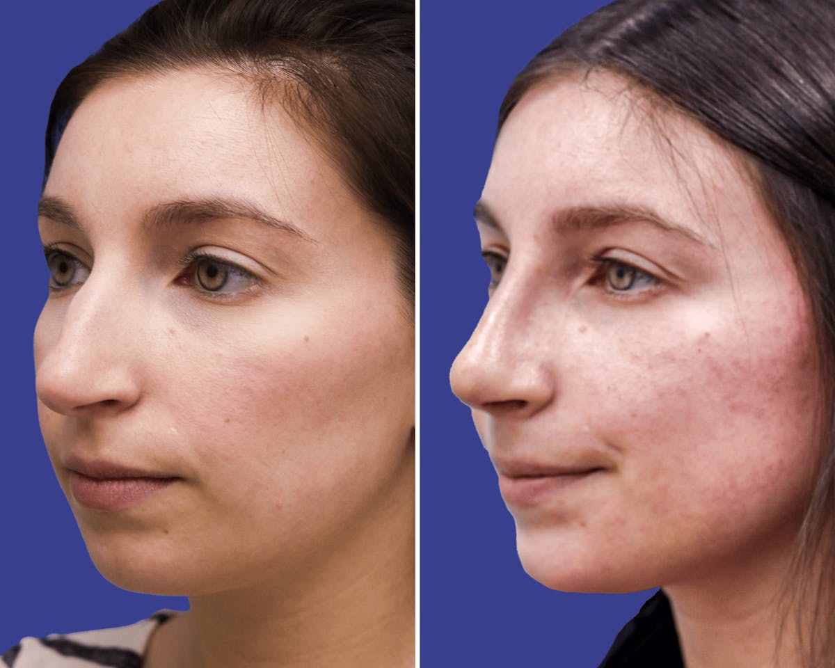 Rhinoplasty Before & After Gallery - Patient 316055 - Image 2