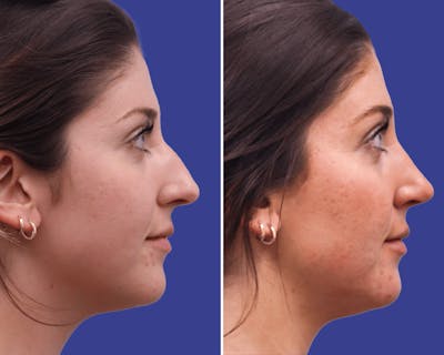 Rhinoplasty Before & After Gallery - Patient 303269 - Image 1