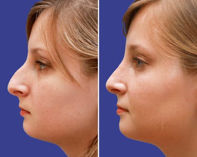 Rhinoplasty Before & After Gallery - Patient 390358 - Image 1