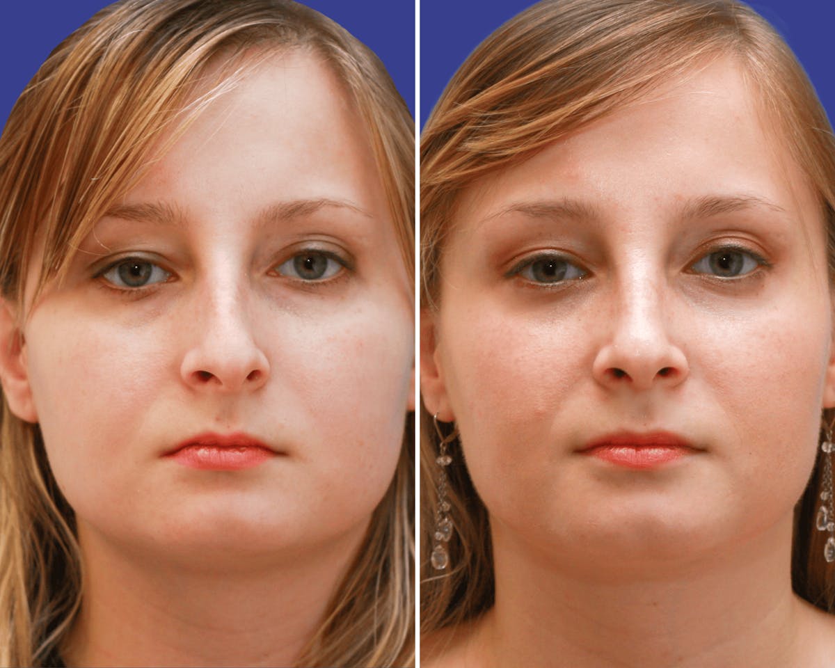 Rhinoplasty Before & After Gallery - Patient 390358 - Image 2