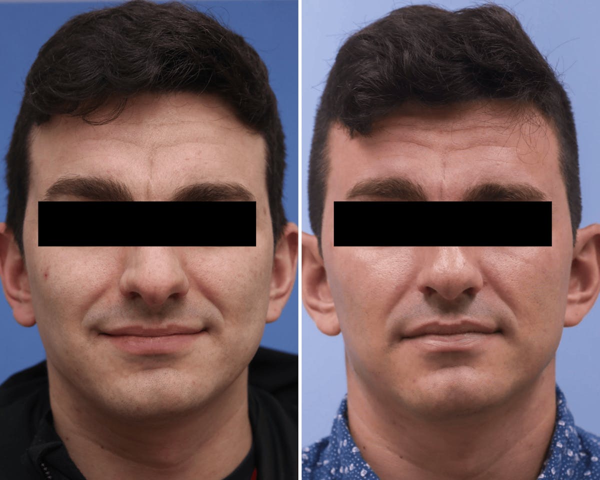 Rhinoplasty Before & After Gallery - Patient 896501 - Image 3