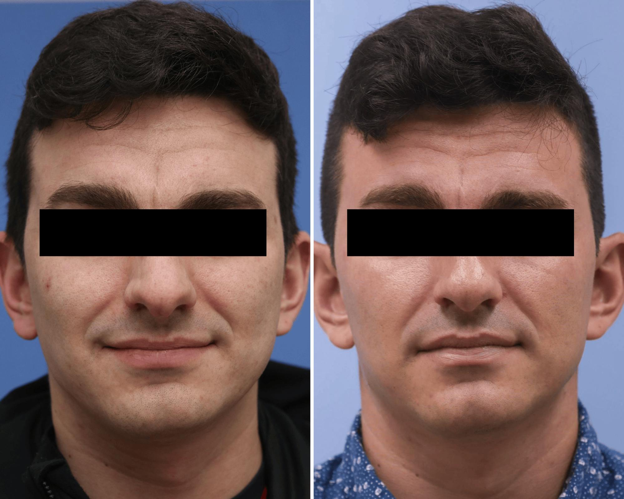 Rhinoplasty Before & After Gallery - Patient 896501 - Image 3