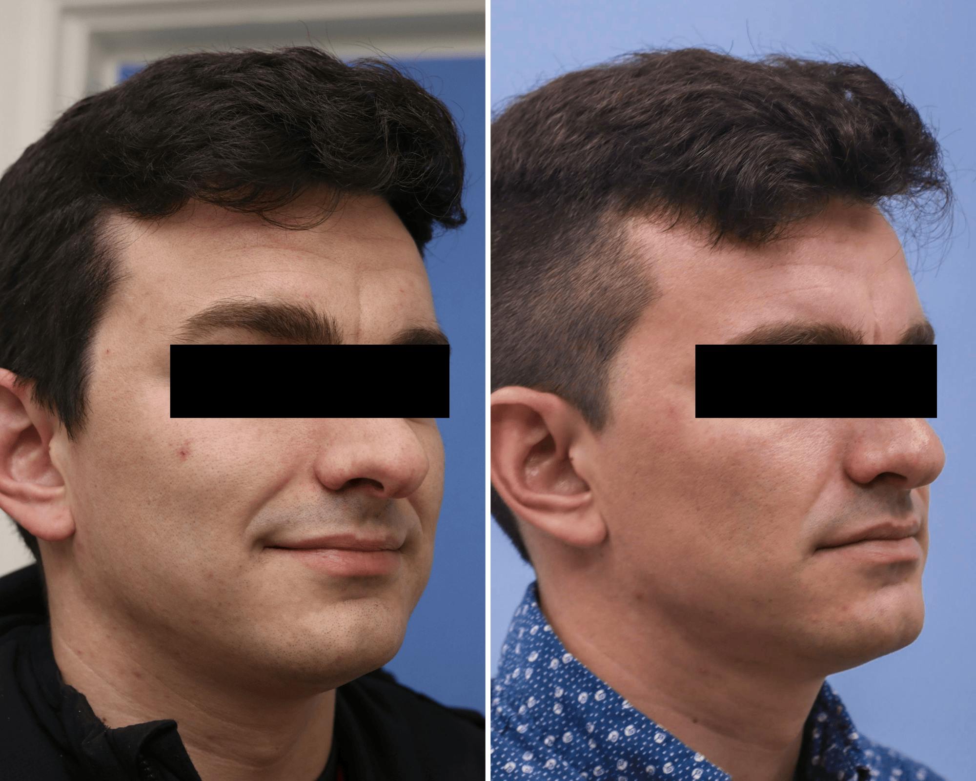 Rhinoplasty Before & After Gallery - Patient 896501 - Image 2