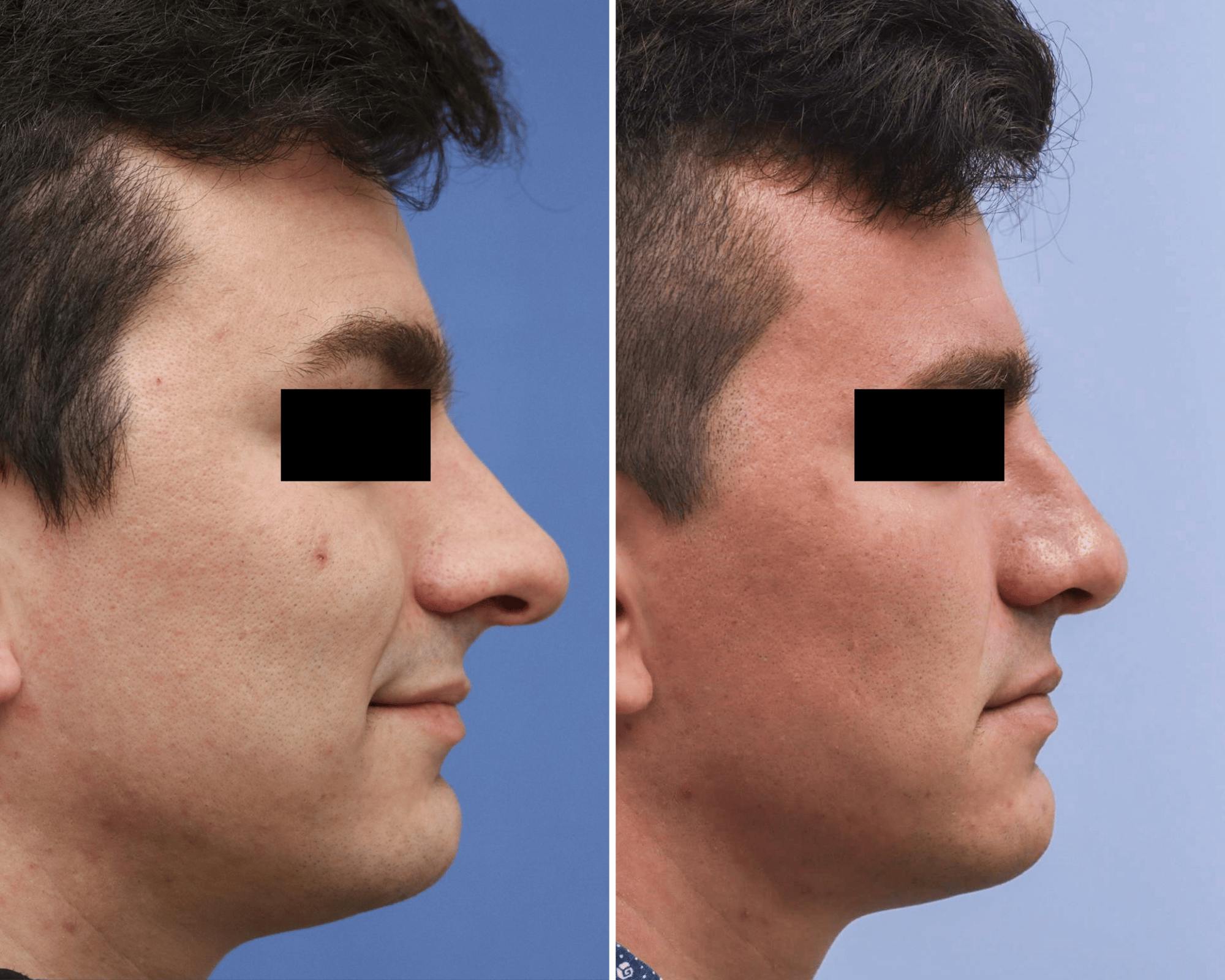 Rhinoplasty Before & After Gallery - Patient 896501 - Image 1