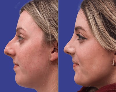 Rhinoplasty Before & After Gallery - Patient 149247 - Image 1