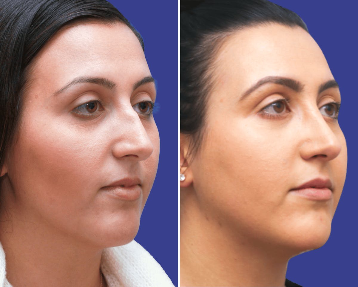 Rhinoplasty Before & After Gallery - Patient 490189 - Image 2