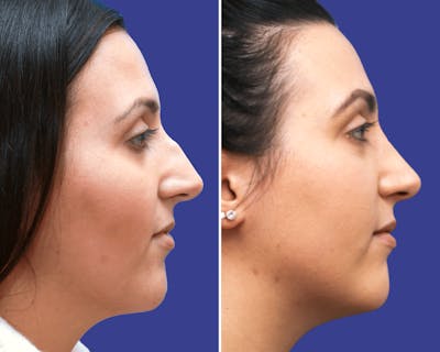 Rhinoplasty Before & After Gallery - Patient 490189 - Image 1