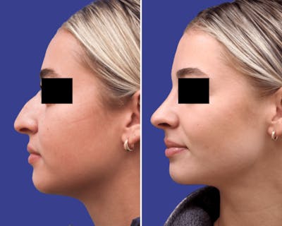 Rhinoplasty Before & After Gallery - Patient 988754 - Image 1