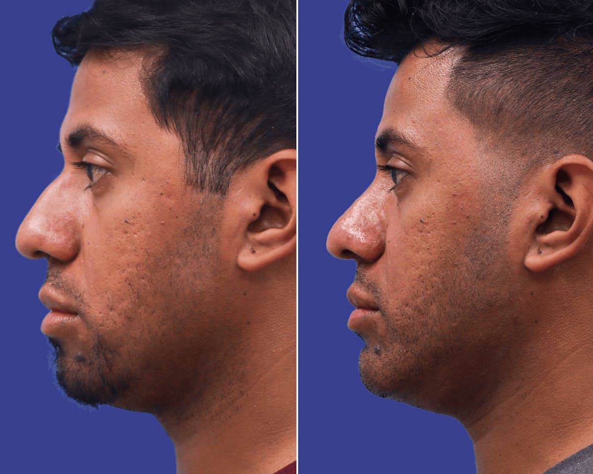 Rhinoplasty Before & After Gallery - Patient 332149 - Image 1