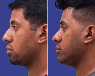 Rhinoplasty Before & After Gallery - Patient 332149 - Image 1