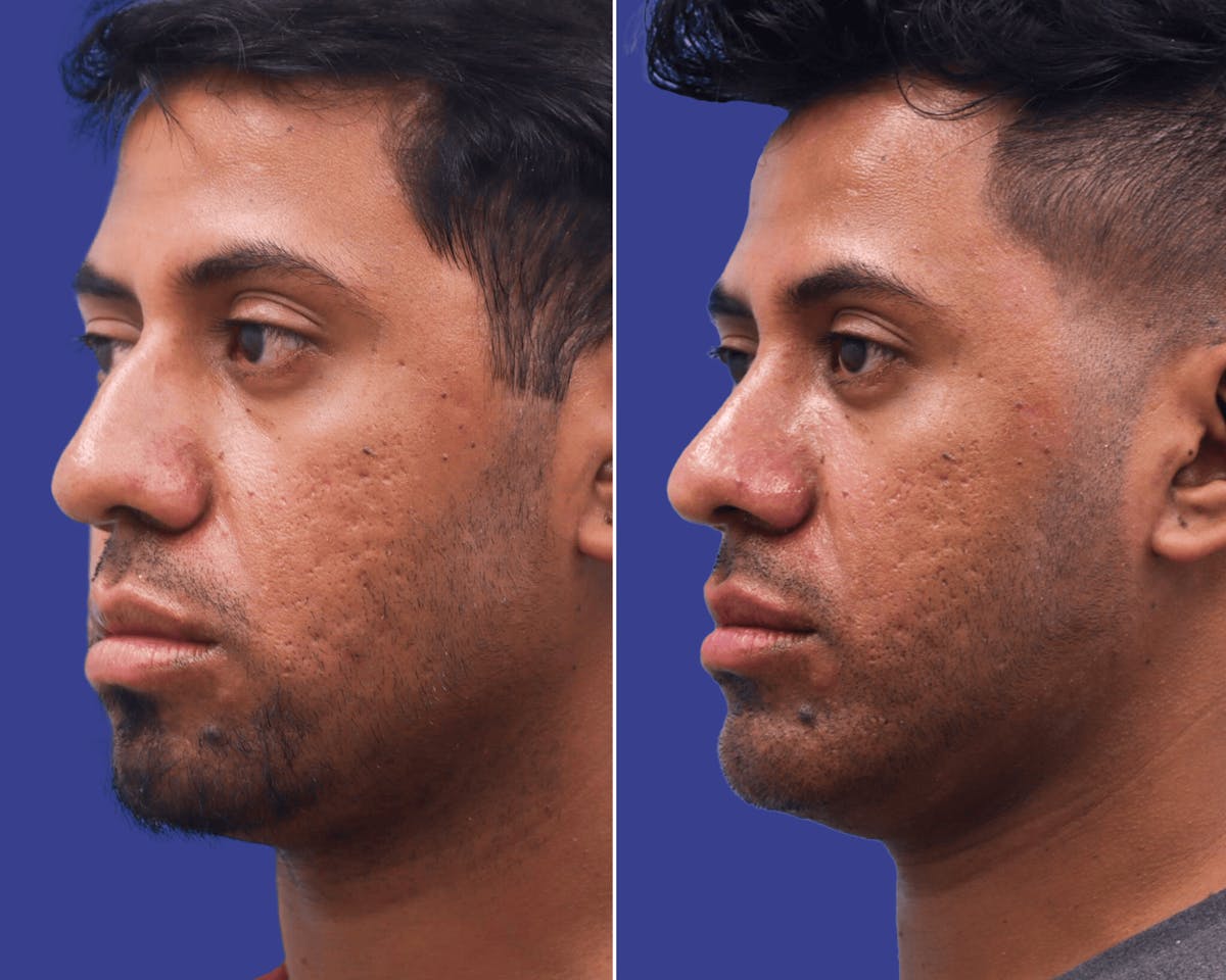 Rhinoplasty Before & After Gallery - Patient 332149 - Image 2