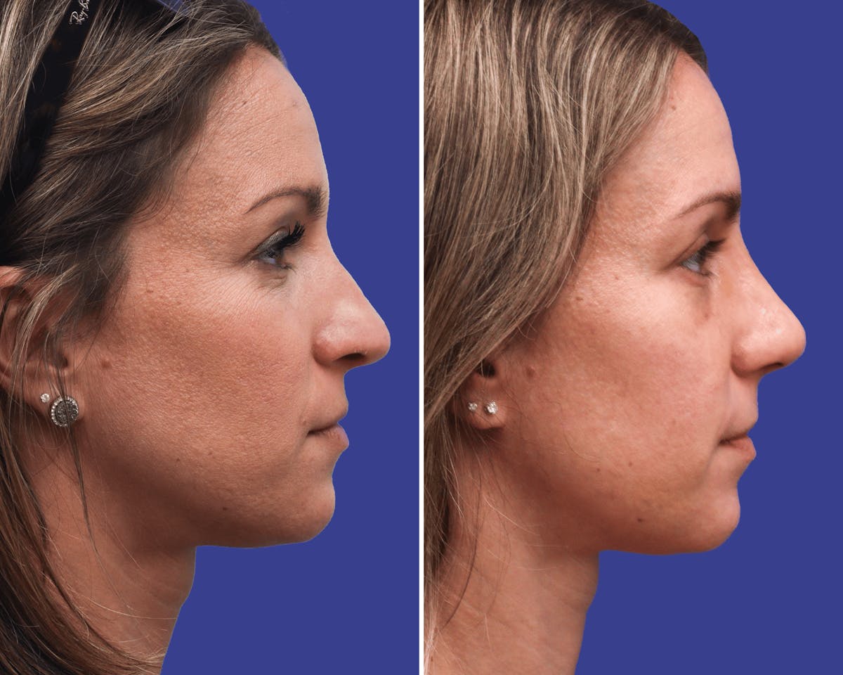 Rhinoplasty Before & After Gallery - Patient 170503 - Image 1