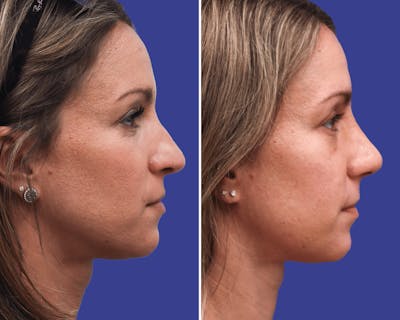 Rhinoplasty Before & After Gallery - Patient 170503 - Image 1
