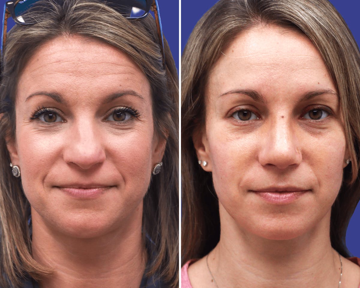 Rhinoplasty Before & After Gallery - Patient 170503 - Image 2