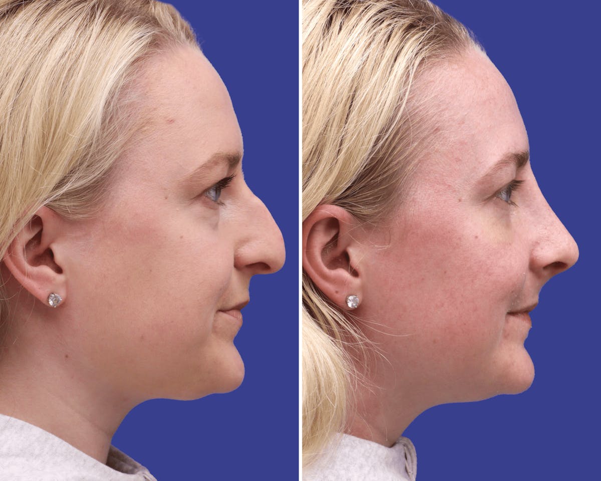 Rhinoplasty Before & After Gallery - Patient 140040 - Image 1